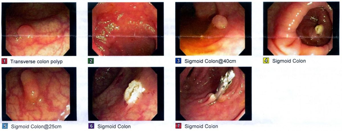 colonoscopy images